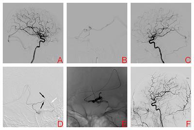 Transvenous embolization of hemorrhagic brain arteriovenous malformations: Case reports and literature review